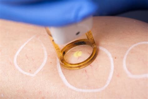 Spider Veins & Lasering .